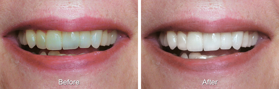Dental before & after photos
