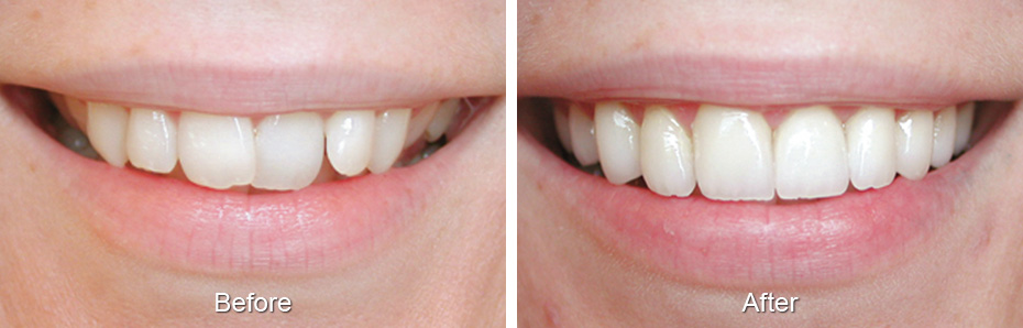 Dental before & after photos